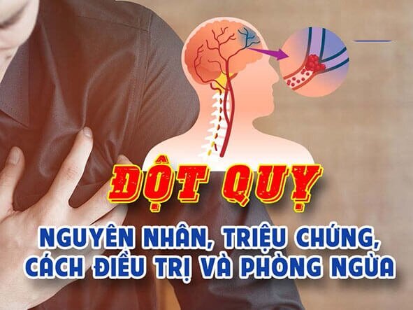 Đột quỵ là bệnh gì? Nguyên nhân, triệu chứng và cách điều trị